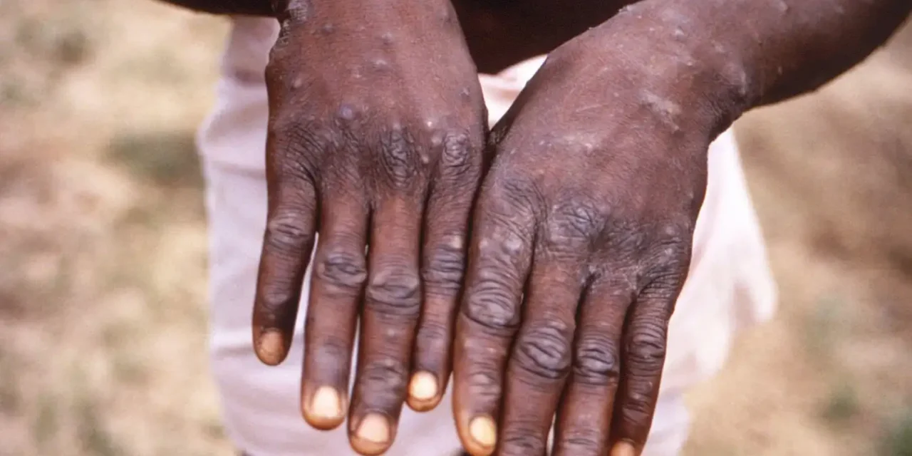 500% Increase in Mpox Cases in Africa
